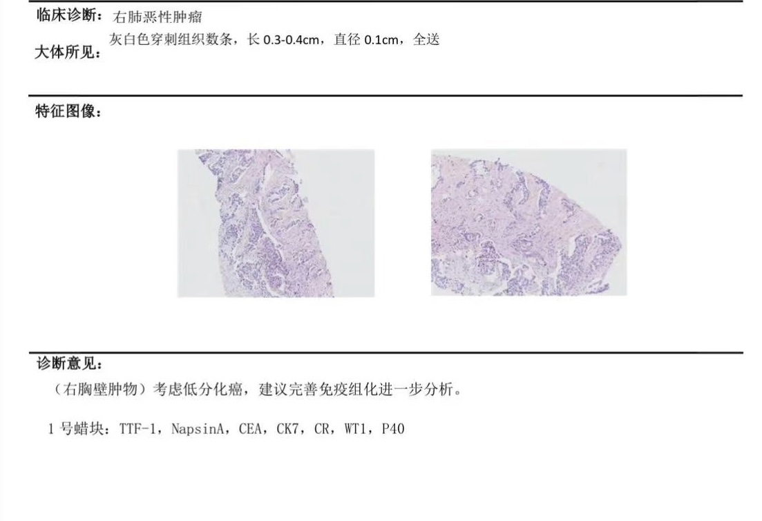 【强技】快、准、稳——超声引导下胸膜转移灶穿刺活检让难题迎刃而解(图3)